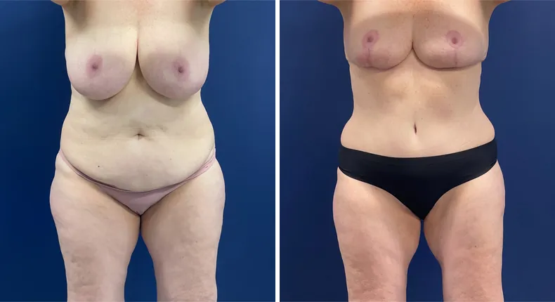 Before and after mommy makeover: patient's body from the front