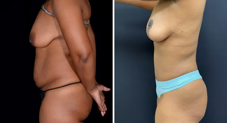 Before and after mommy makeover: patient's body from the left side, with tummy tuck