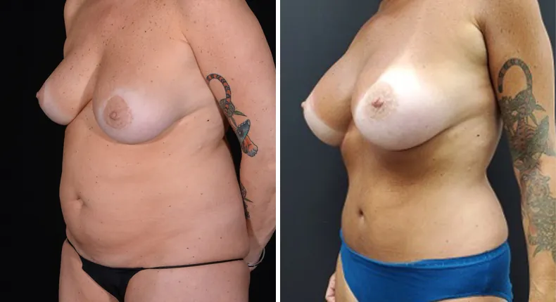 Before and after mommy makeover: woman's body at a left angle