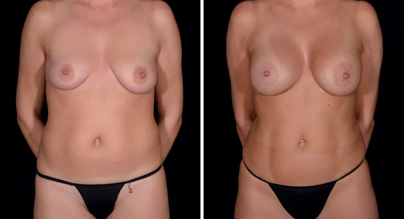 Before and after mommy makeover: patient's body from the front
