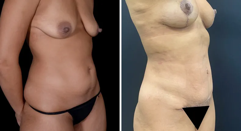 Before and after mommy makeover: woman's body at a right angle
