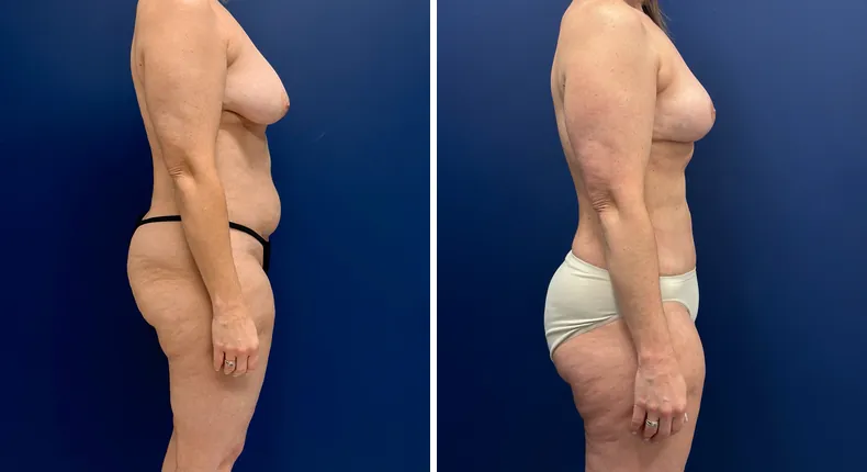 Before and after mommy makeover: woman's body, with breast lift, tummy tuck and liposuction