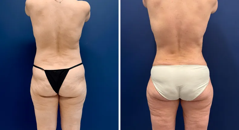 Before and after mommy makeover: woman's body, with breast lift, tummy tuck and liposuction