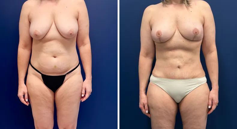 Before and after mommy makeover: woman's body, with breast lift, tummy tuck and liposuction