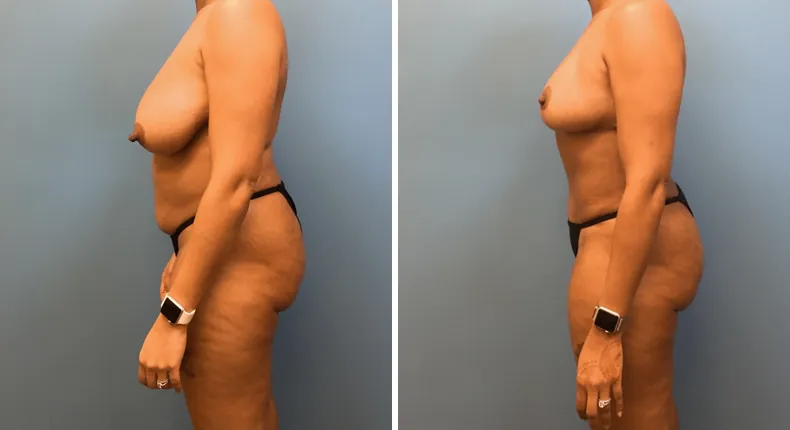 Before and after mommy makeover: patient's body from the left side