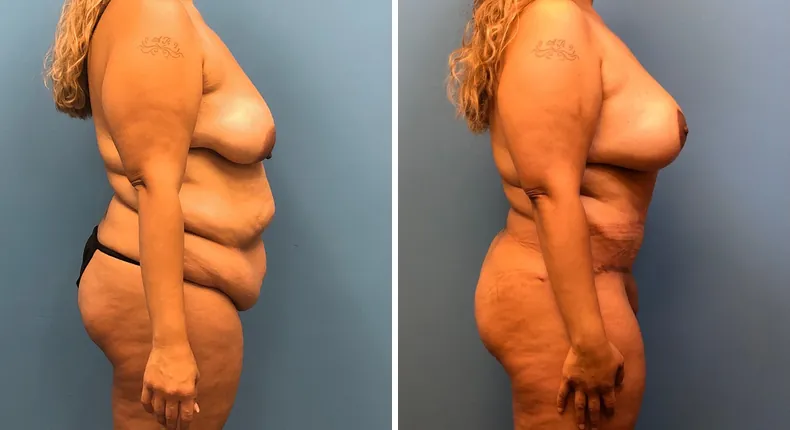 Before and after mommy makeover: woman's body from the right side
