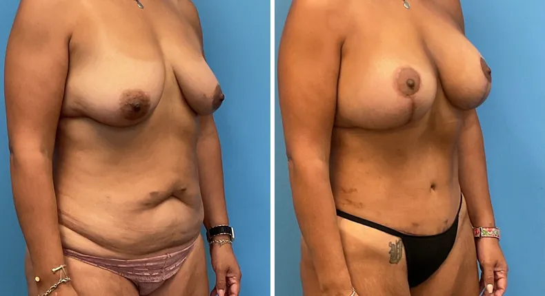 Before and after mommy makeover: woman's body at a right angle