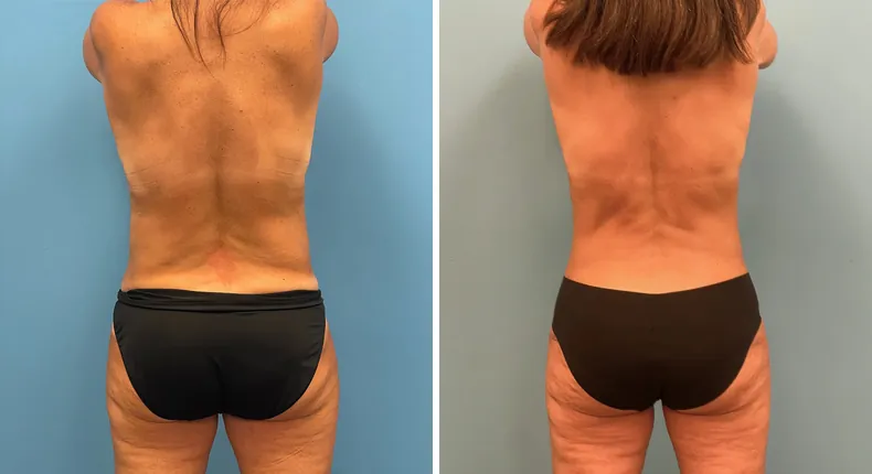 Before and after mommy makeover: woman's body from the back