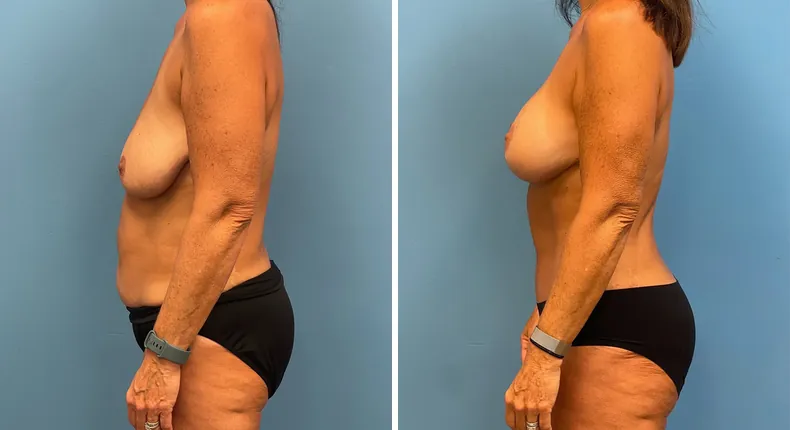 Before and after mommy makeover: woman's body in left profile