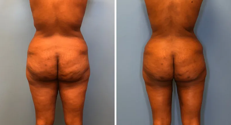 Before and after mommy makeover: woman's body from the back