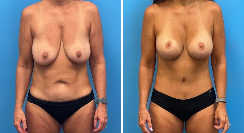 Before and after mommy makeover: woman's body from the front