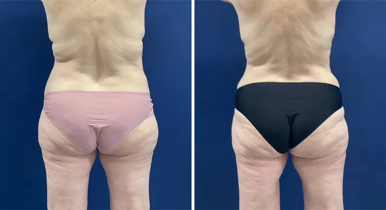 Before and after mommy makeover: patient's body from the back