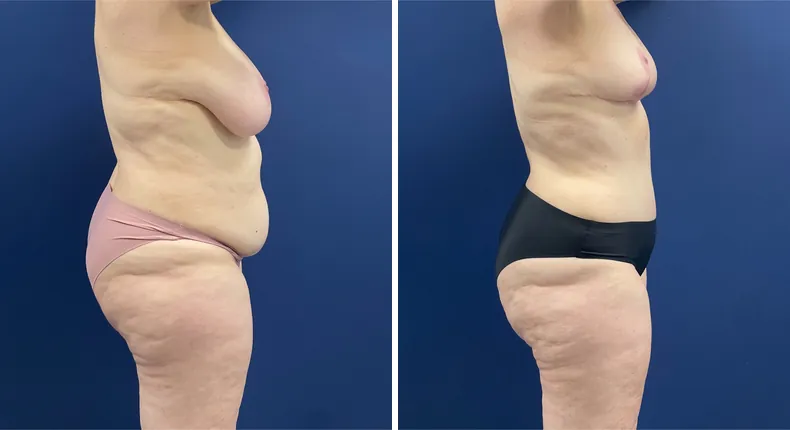Before and after mommy makeover: patient's body from the right side