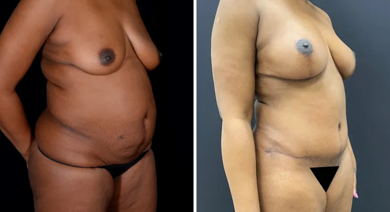 Before and after mommy makeover: patient's body at a right angle