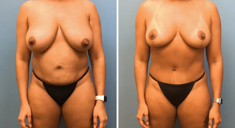 Before and after mommy makeover: patient's body from the front