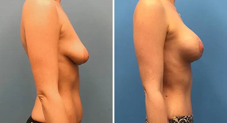 Before and after mommy makeover: woman's body from the right side
