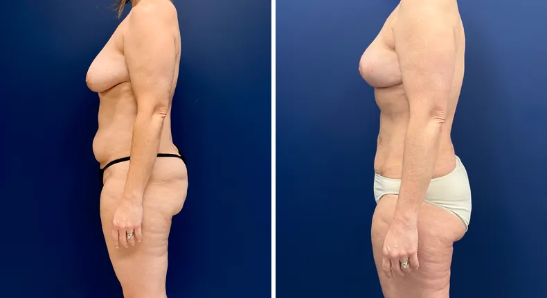 Before and after mommy makeover: woman's body, with breast lift, tummy tuck and liposuction