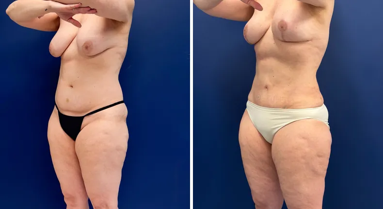 Before and after mommy makeover: woman's body, with breast lift, tummy tuck and liposuction