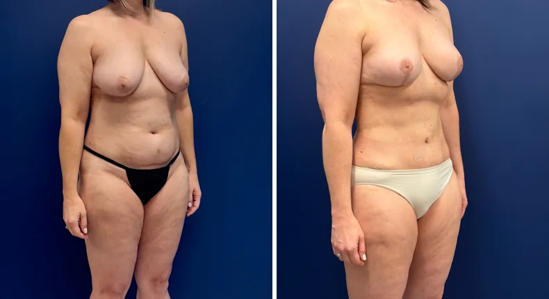 Before and after mommy makeover: woman's body, with breast lift, tummy tuck and liposuction