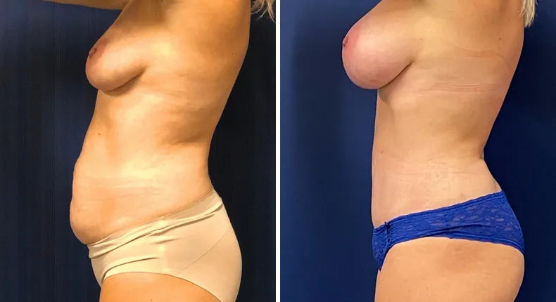 Before and after mommy makeover: patient's body from the left side