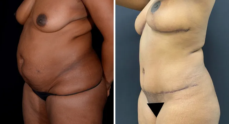 Before and after mommy makeover: patient's body at a left angle