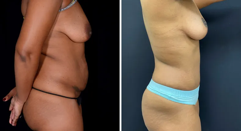 Before and after mommy makeover: patient's body from the right side, with tummy tuck