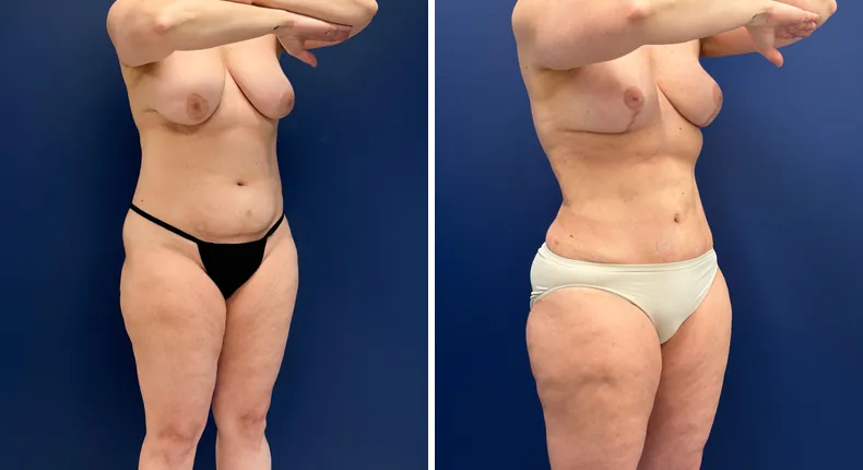 Before and after mommy makeover: woman's body, with breast lift, tummy tuck and liposuction
