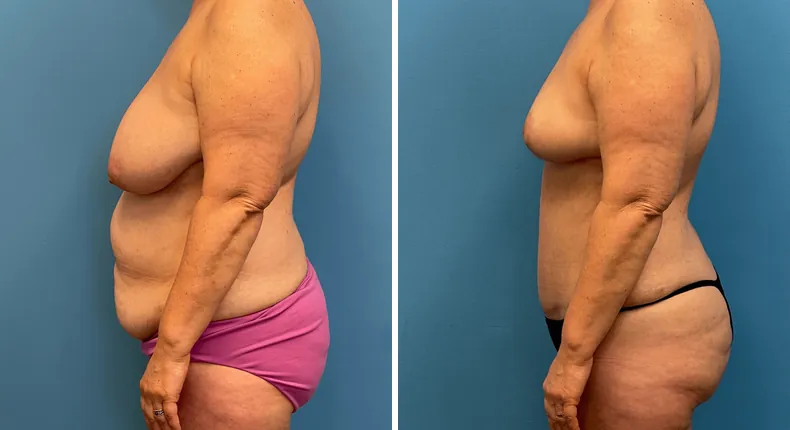 Before and after mommy makeover: woman's body in left profile
