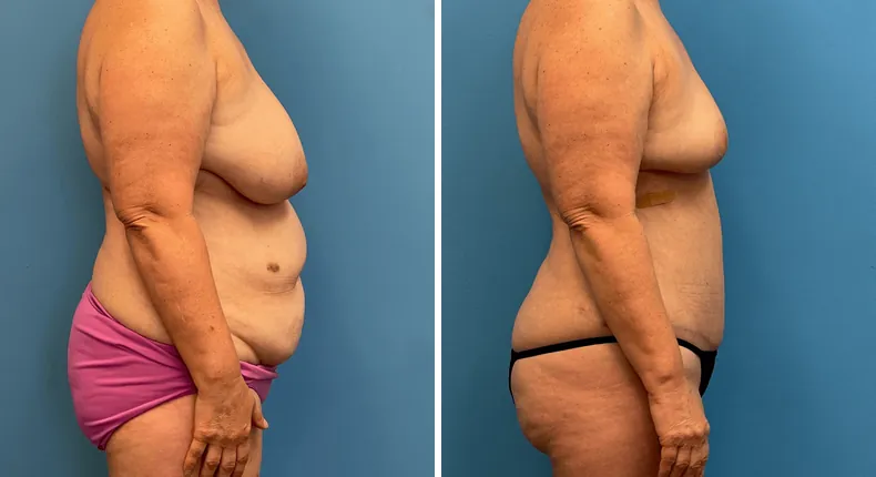 Before and after mommy makeover: woman's body in right profile