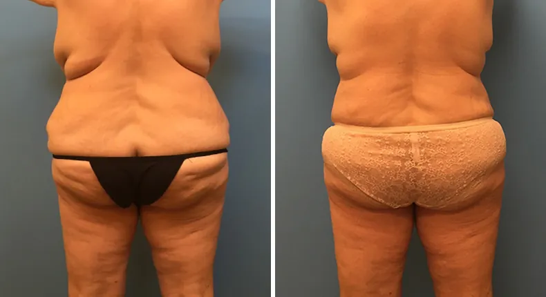 Before and after mommy makeover: woman's body from the back