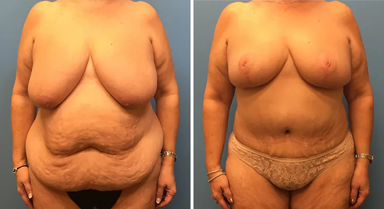 Before and after mommy makeover: woman's body from the front