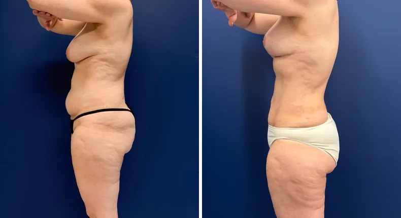 Before and after mommy makeover: woman's body, with breast lift, tummy tuck and liposuction