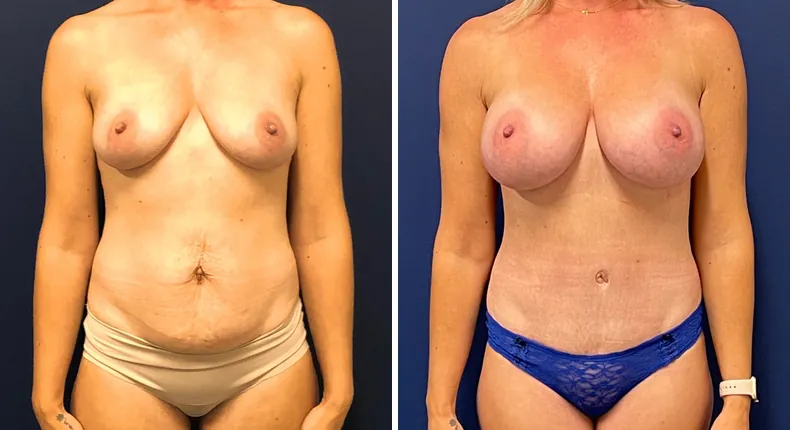 Before and after mommy makeover: patient's body from the front