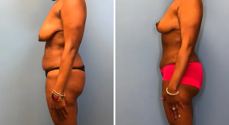 Before and after mommy makeover: woman's body from the left side