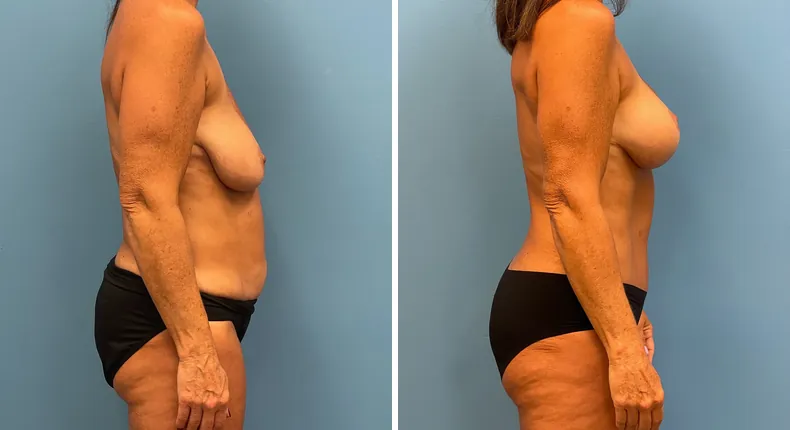 Before and after mommy makeover: woman's body in right profile