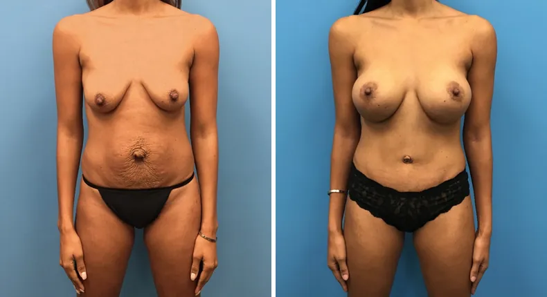 Before and after mommy makeover: woman's body
