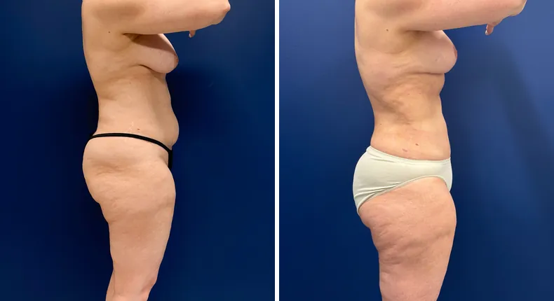 Before and after mommy makeover: woman's body, with breast lift, tummy tuck and liposuction
