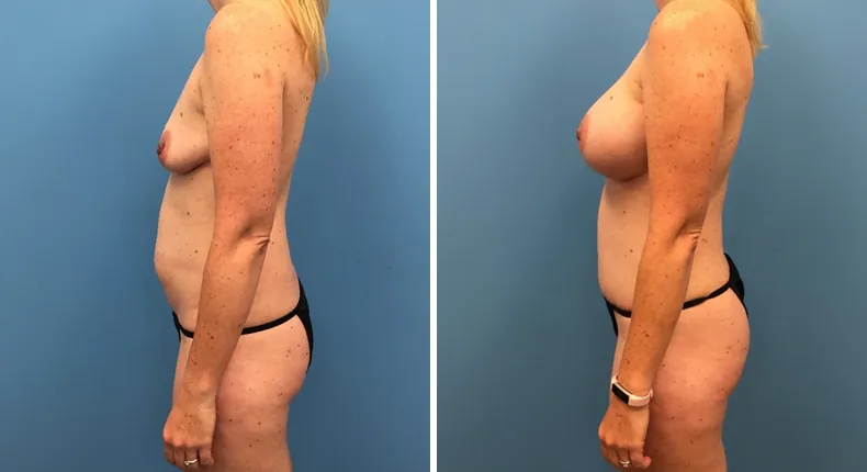 Before and after mommy makeover: patient's body from the left side