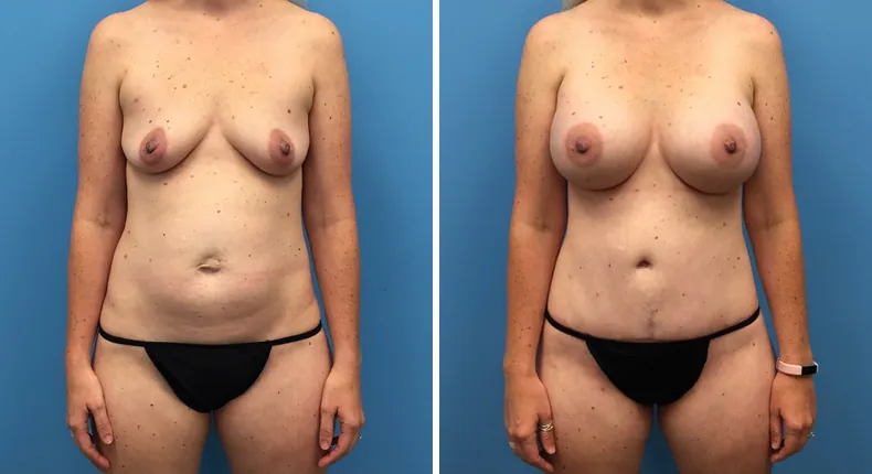Before and after mommy makeover: patient's body from the front