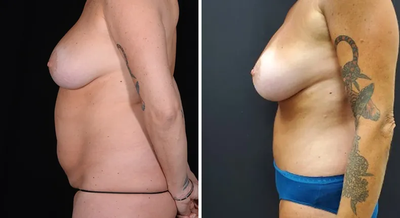 Before and after mommy makeover: woman's body from the left side
