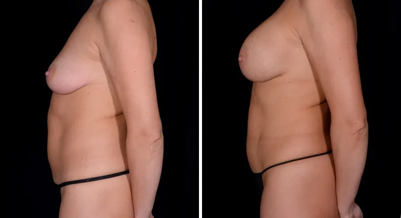 Before and after mommy makeover: patient's body from the left side