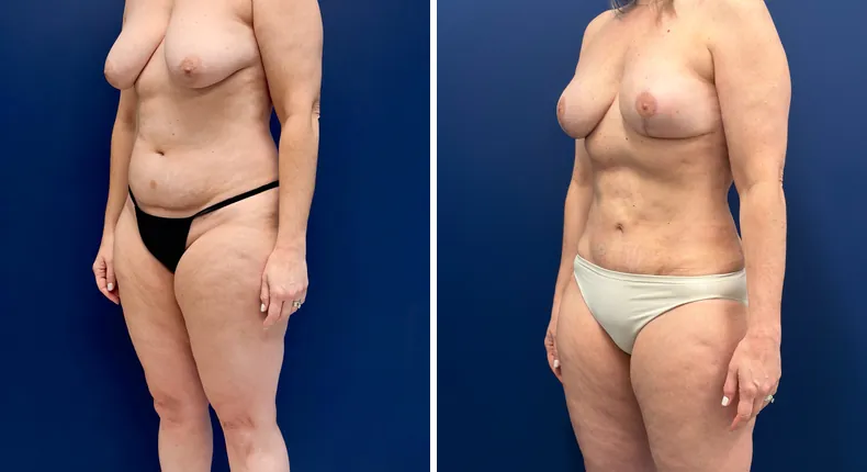 Before and after mommy makeover: woman's body, with breast lift, tummy tuck and liposuction
