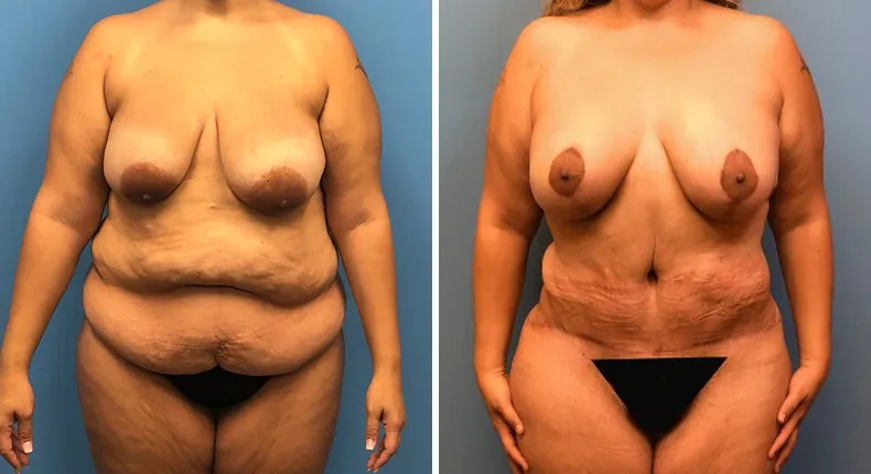 Before and after mommy makeover: woman's body from the front