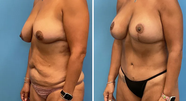 Before and after mommy makeover: woman's body at a right angle