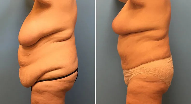 Before and after mommy makeover: woman's body at a left angle