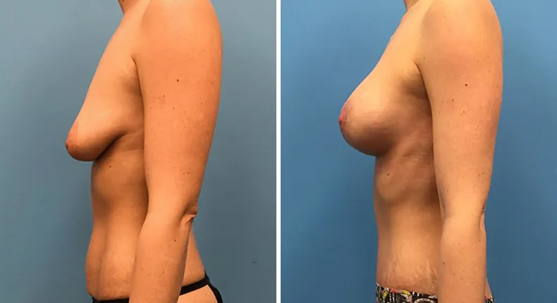 Before and after mommy makeover: woman's body from the left side