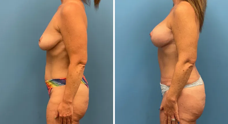 Before and after mommy makeover: woman's body from the left side