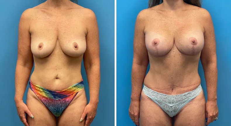 Before and after mommy makeover: woman's body from the front