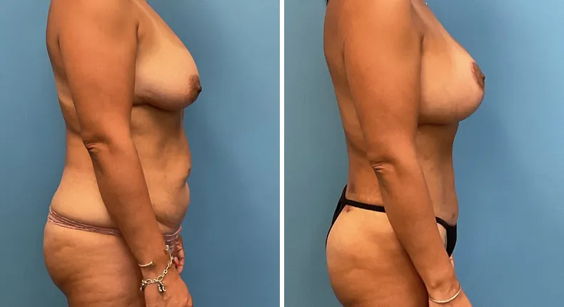 Before and after mommy makeover: woman's body from the right side