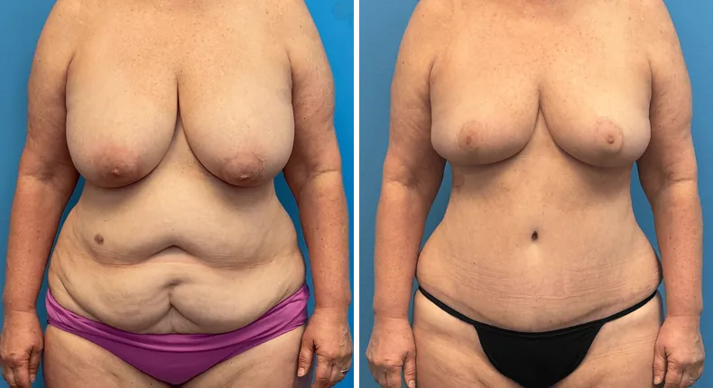 Before and after mommy makeover: woman's body from the front